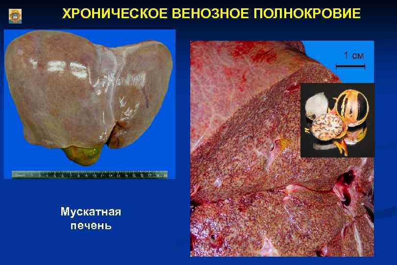 ХРОНИЧЕСКОЕ ВЕНОЗНОЕ ПОЛНОКРОВИЕ Мускатная печень 