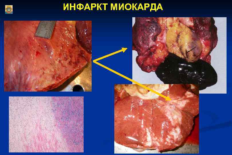 ИНФАРКТ МИОКАРДА 