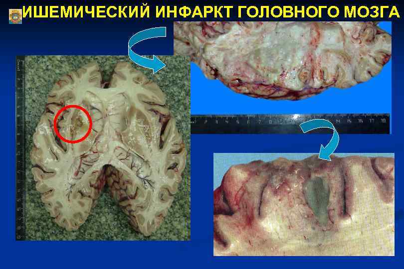 ИШЕМИЧЕСКИЙ ИНФАРКТ ГОЛОВНОГО МОЗГА 