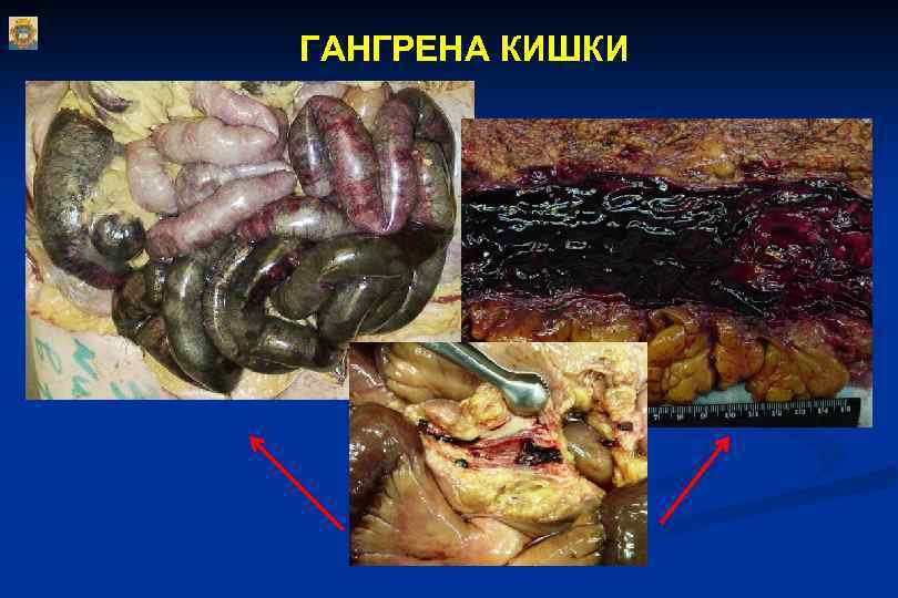 ГАНГРЕНА КИШКИ 