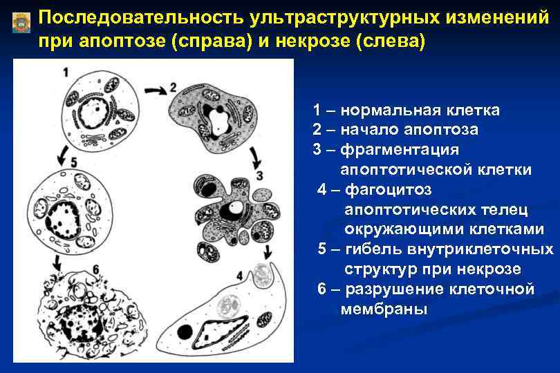 Последовательность ультраструктурных изменений при апоптозе (справа) и некрозе (слева) 1 – нормальная клетка 2