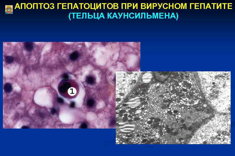 АПОПТОЗ ГЕПАТОЦИТОВ ПРИ ВИРУСНОМ ГЕПАТИТЕ (ТЕЛЬЦА КАУНСИЛЬМЕНА) 