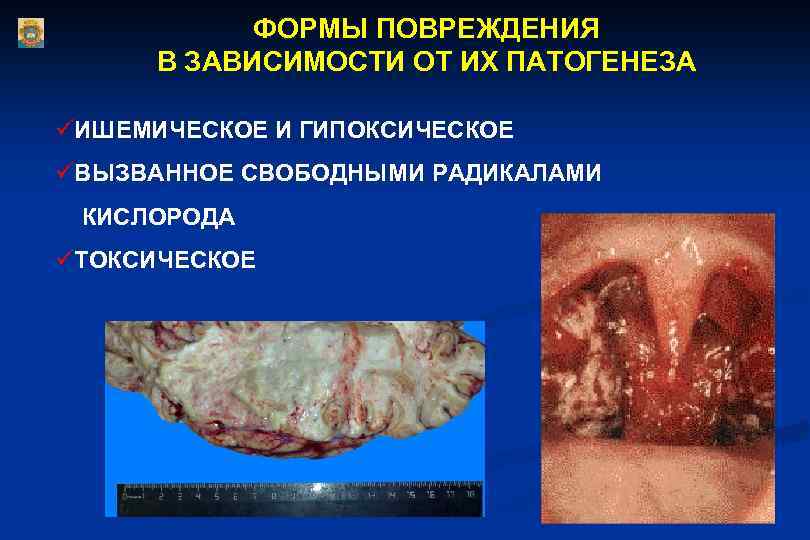 ФОРМЫ ПОВРЕЖДЕНИЯ В ЗАВИСИМОСТИ ОТ ИХ ПАТОГЕНЕЗА üИШЕМИЧЕСКОЕ И ГИПОКСИЧЕСКОЕ üВЫЗВАННОЕ СВОБОДНЫМИ РАДИКАЛАМИ КИСЛОРОДА