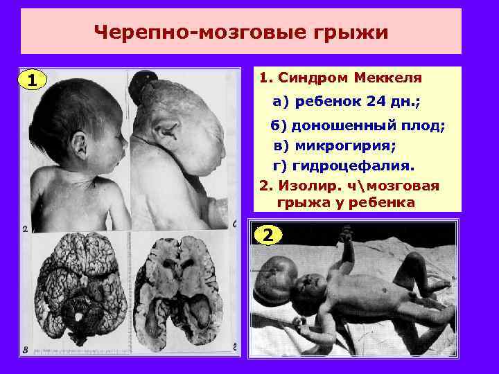 Черепно-мозговые грыжи 1 1. Синдром Меккеля а) ребенок 24 дн. ; б) доношенный плод;