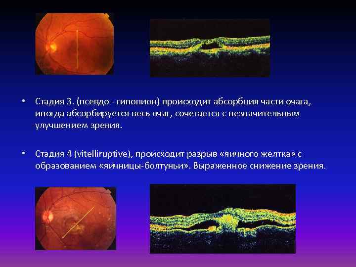  • Стадия 3. (псевдо - гипопион) происходит абсорбция части очага, иногда абсорбируется весь