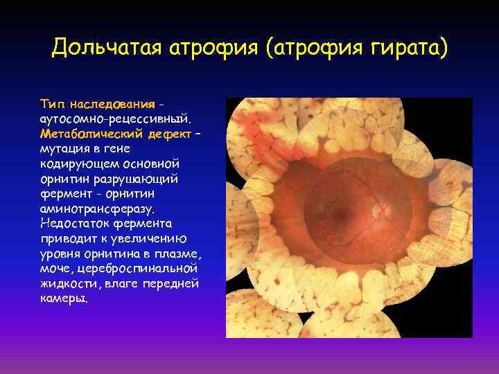 Дольчатая атрофия (атрофия гирата) Тип наследования аутосомно-рецессивный. Метаболический дефект – мутация в гене кодирующем