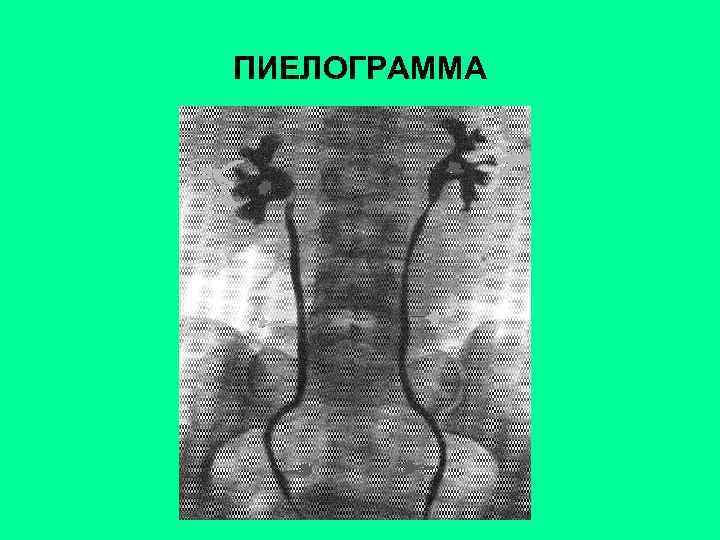 ПИЕЛОГРАММА 