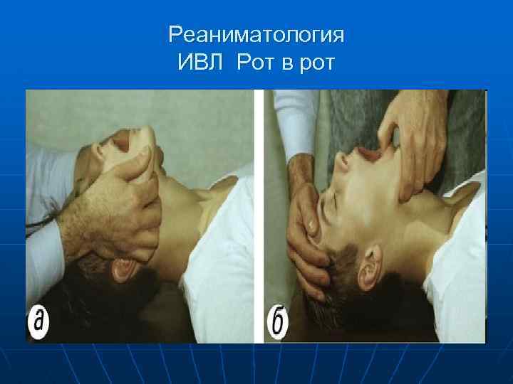 Реаниматология ИВЛ Рот в рот 