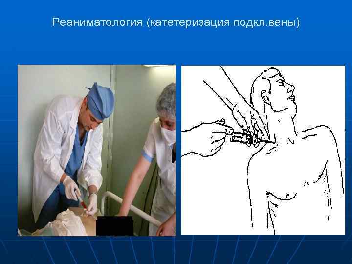 Реаниматология (катетеризация подкл. вены) 