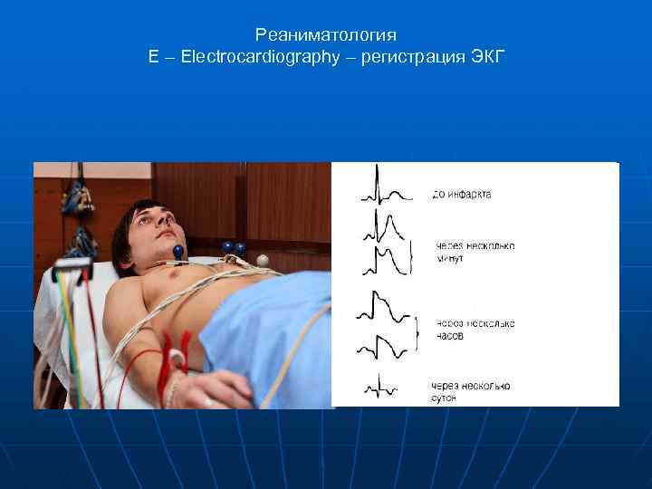 Реаниматология E – Electrocardiography – регистрация ЭКГ 