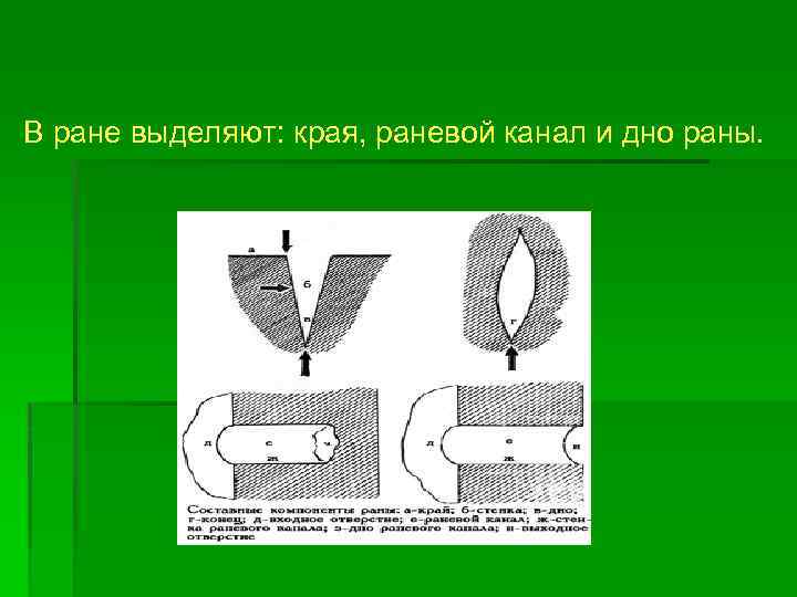 В ране выделяют: края, раневой канал и дно раны. 