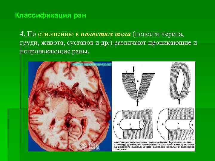 Классификация ран 4. По отношению к полостям тела (полости черепа, груди, живота, суставов и