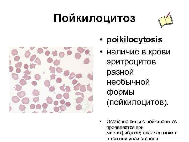 Пойкилоцитоз • poikilocytosis • наличие в крови эритроцитов разной необычной формы (пойкилоцитов). • Особенно