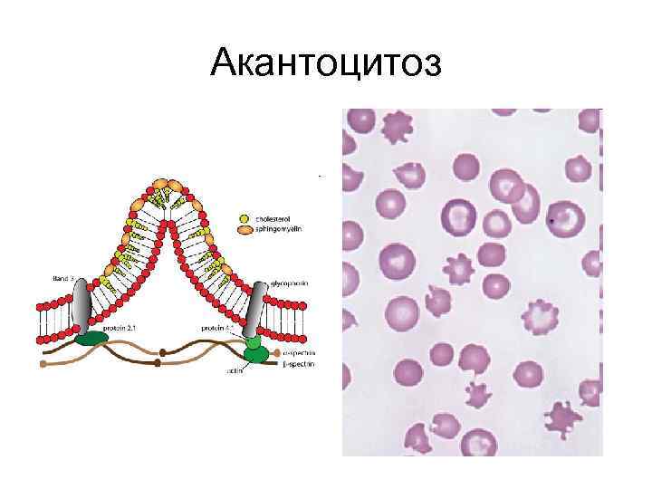Акантоцитоз 