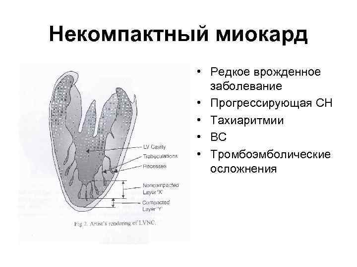 Некомпактный миокард • Редкое врожденное заболевание • Прогрессирующая СН • Тахиаритмии • ВС •