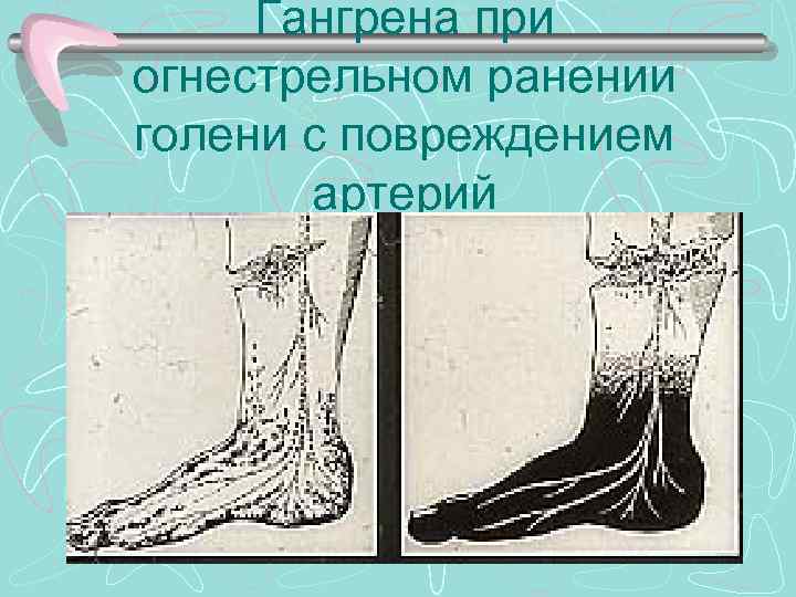 Гангрена при огнестрельном ранении голени с повреждением артерий 