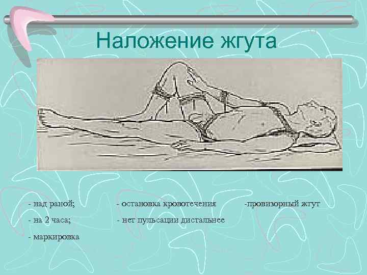 Наложение жгута - над раной; - остановка кровотечения - на 2 часа; - нет