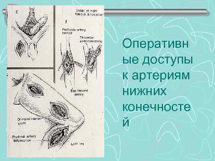 Оперативн ые доступы к артериям нижних конечносте й 