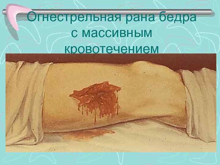 Огнестрельная рана бедра с массивным кровотечением 