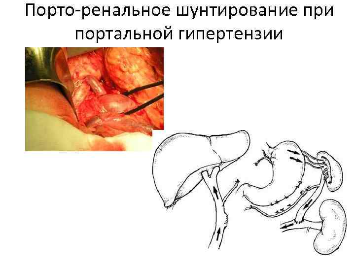 Порто-ренальное шунтирование при портальной гипертензии 