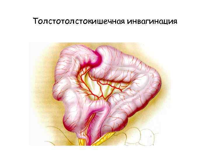 Толстотолстокишечная инвагинация 