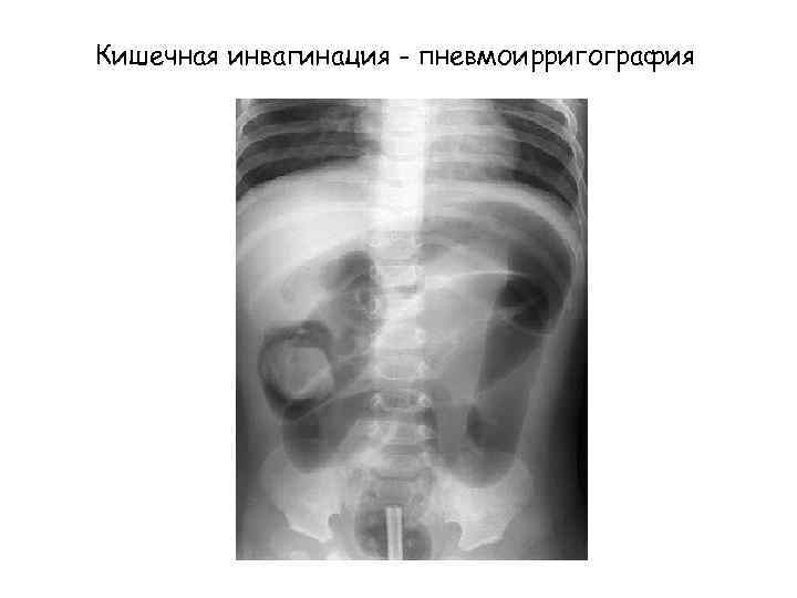 Кишечная инвагинация - пневмоирригография 