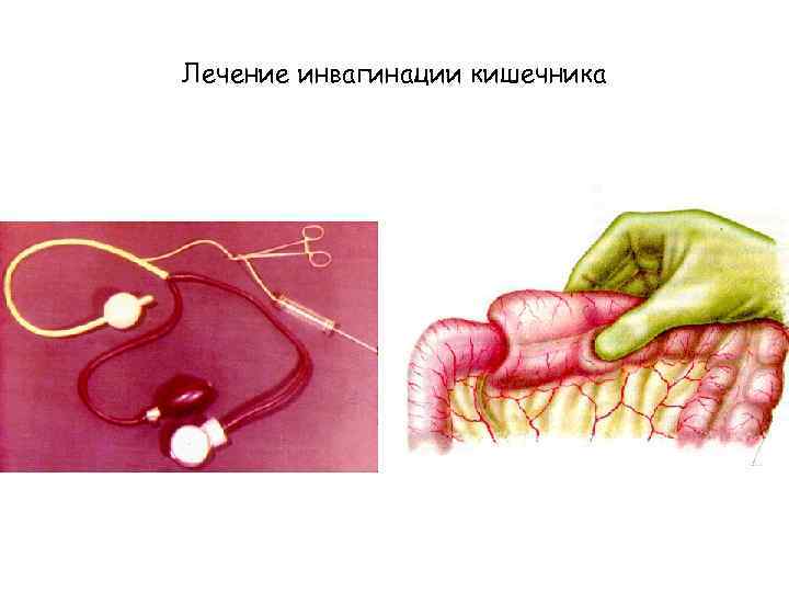 Лечение инвагинации кишечника 