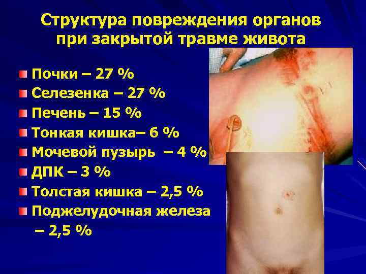 Структура повреждения органов при закрытой травме живота Почки – 27 % Селезенка – 27