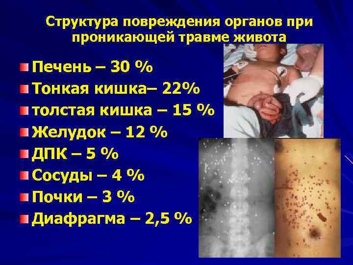 Структура повреждения органов при проникающей травме живота Печень – 30 % Тонкая кишка– 22%