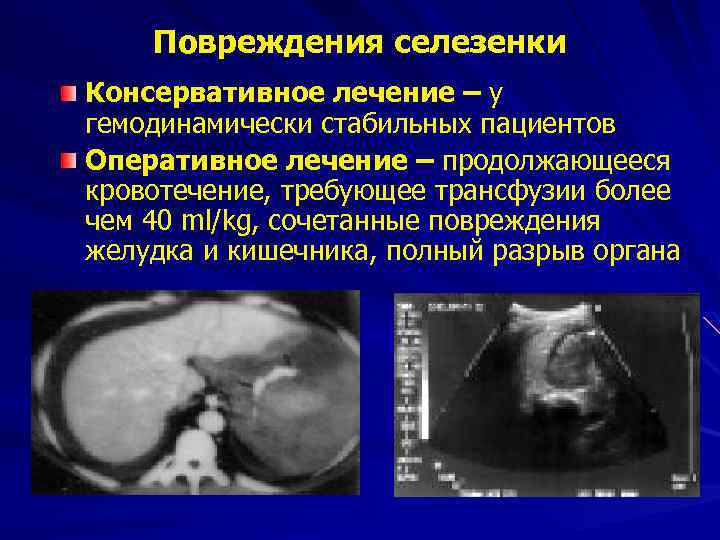 Повреждения селезенки Консервативное лечение – у гемодинамически стабильных пациентов Оперативное лечение – продолжающееся кровотечение,