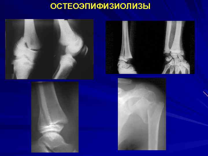 ОСТЕОЭПИФИЗИОЛИЗЫ 