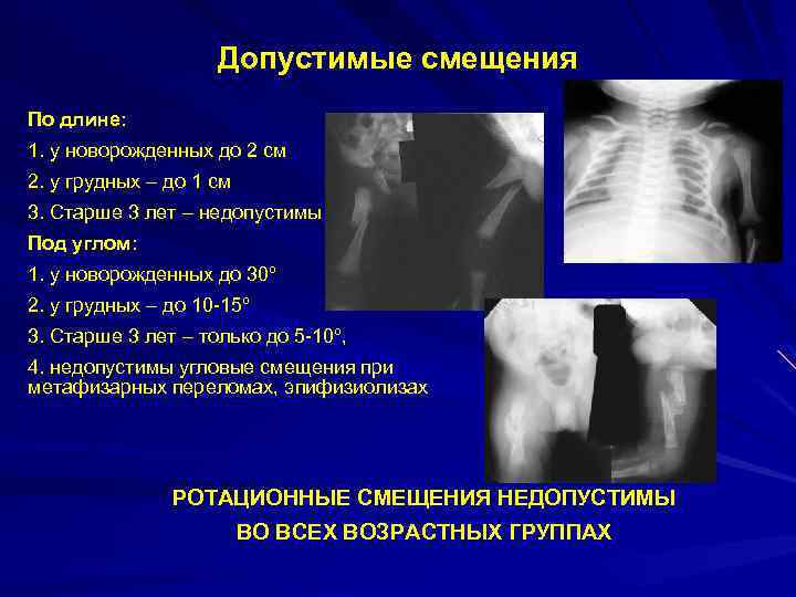 Допустимые смещения По длине: 1. у новорожденных до 2 см 2. у грудных –