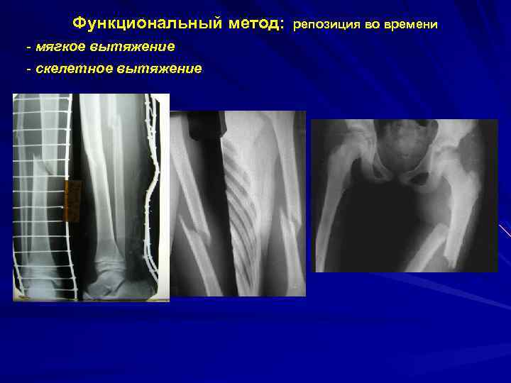 Функциональный метод: - мягкое вытяжение - скелетное вытяжение репозиция во времени 