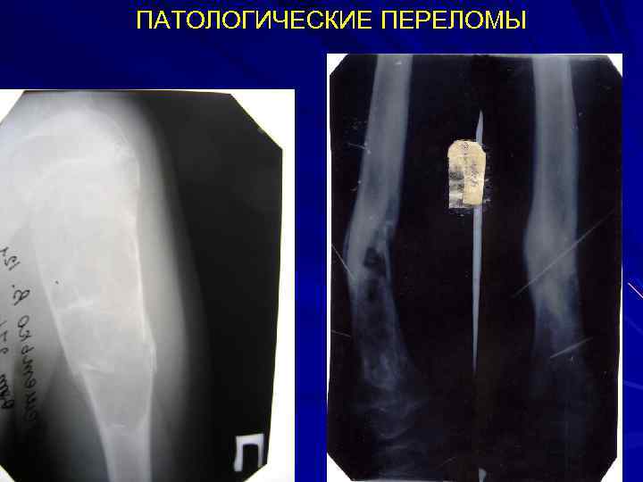 ПАТОЛОГИЧЕСКИЕ ПЕРЕЛОМЫ 