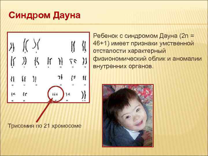 Синдром Дауна Ребенок с синдромом Дауна (2 n = 46+1) имеет признаки умственной отсталости