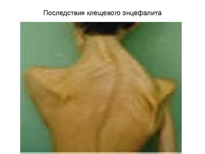 Последствия клещевого энцефалита 