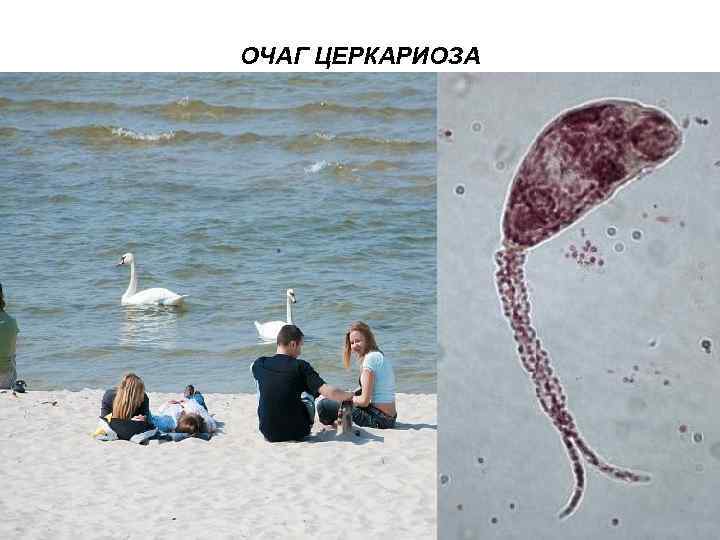 ОЧАГ ЦЕРКАРИОЗА 