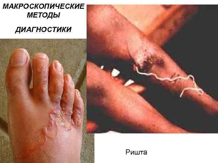 МАКРОСКОПИЧЕСКИЕ МЕТОДЫ ДИАГНОСТИКИ Ришта 