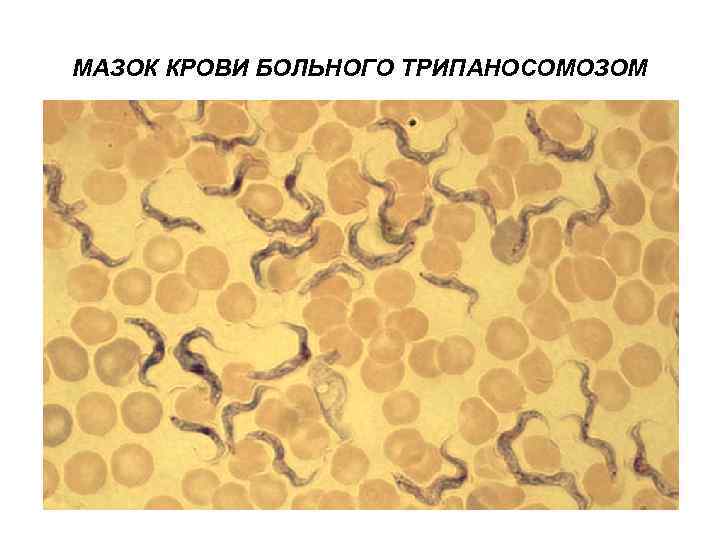 МАЗОК КРОВИ БОЛЬНОГО ТРИПАНОСОМОЗОМ 
