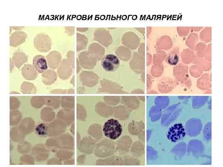 МАЗКИ КРОВИ БОЛЬНОГО МАЛЯРИЕЙ 
