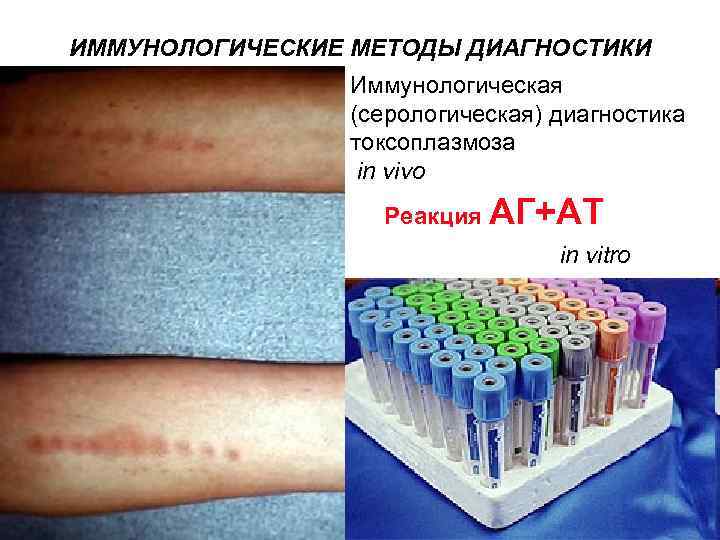 ИММУНОЛОГИЧЕСКИЕ МЕТОДЫ ДИАГНОСТИКИ Иммунологическая (серологическая) диагностика токсоплазмоза in vivo Реакция АГ+АТ in vitro 