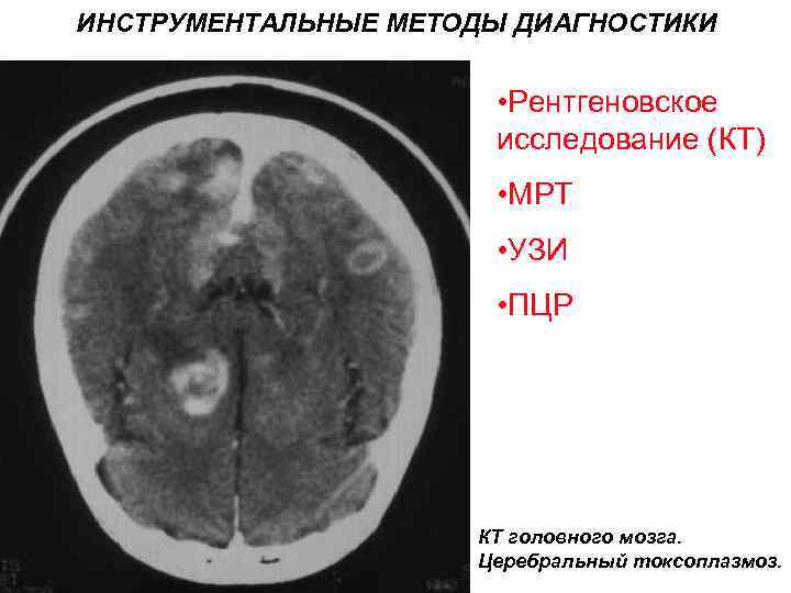 ИНСТРУМЕНТАЛЬНЫЕ МЕТОДЫ ДИАГНОСТИКИ • Рентгеновское исследование (КТ) • МРТ • УЗИ • ПЦР КТ