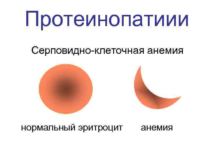 Протеинопатиии Серповидно-клеточная анемия нормальный эритроцит анемия 