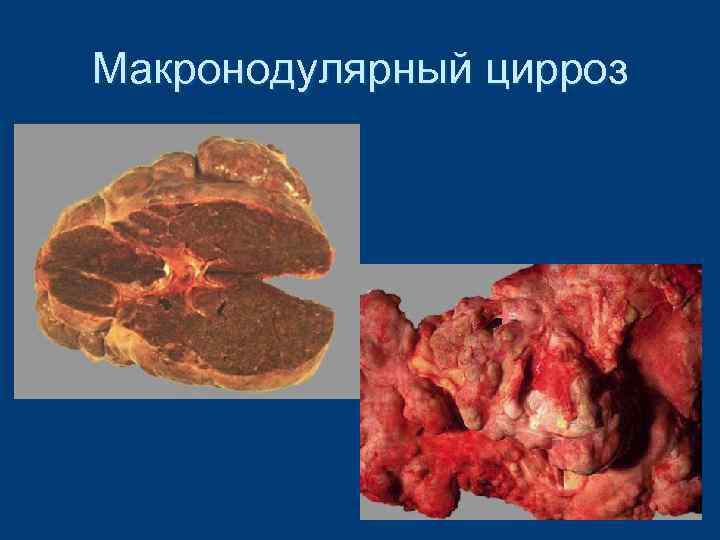 Макронодулярный цирроз 