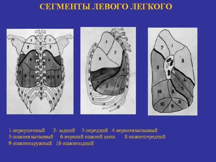 СЕГМЕНТЫ ЛЕВОГО ЛЕГКОГО 1 -верхушечный 2 - задний 3 -передний 4 -верхнеязычковый 5 -нижнеязычковый