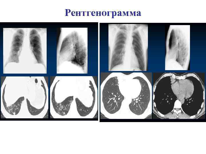 Рентгенологическая картина пневмонии лучевая диагностика