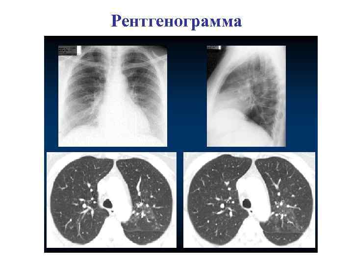 Плевропневмония. Плевропневмония очаговая. Плевропневмония рентген.