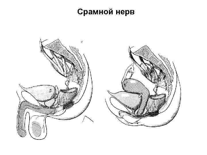 Срамной нерв 