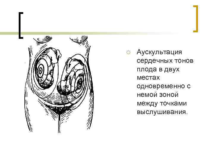 ¡ Аускультация сердечных тонов плода в двух местах одновременно с немой зоной между точками