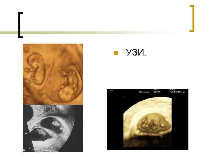 n УЗИ. 